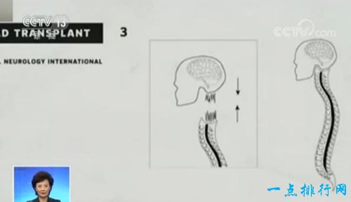 中国教授完成全球首例人类换头术 历时18个小时