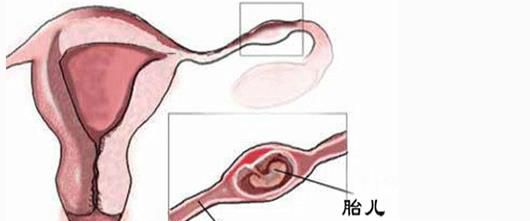 宫外孕早期症状