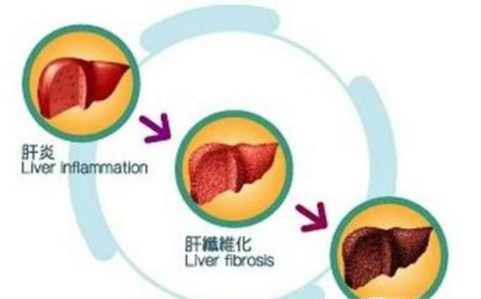 肝硬化如何定义 肝硬化的症状有哪些